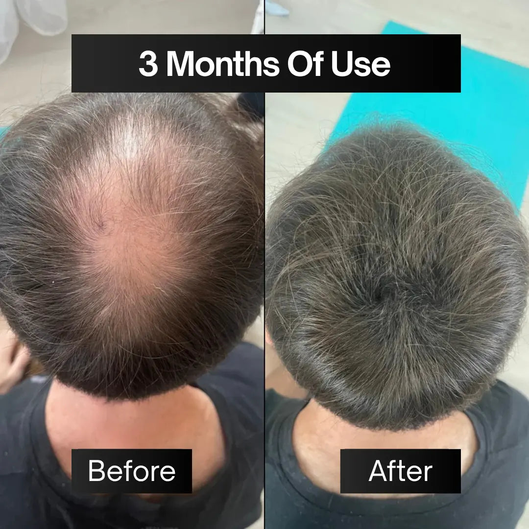 Full Pack | Hair Filler + Serum + Derma Roller