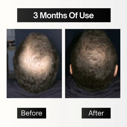 Full Pack | Hair Filler + Serum + Derma Roller